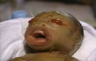 Куда катится мир... В Малайзии родился ребенок с вывернутыми наизнаку глазами. Фото