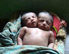 Двухголовый младенец умер из-за бедности родителей. Фото