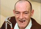 Ветеран вырвал себе 13 зубов. Плоскогубцами. Фото