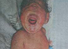 В Индии родился ребенок-циклоп. Врачи чуть не упали в обморок. Фото