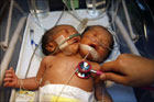 На Филиппинах родился ребенок с двумя головами. Фото