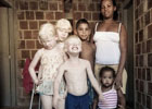 В Бразилии в семье чернокожих родились совсем необычные дети. Фото