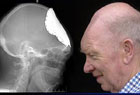 Невероятно, но факт. У 72-летнего британского почтальона вырос новый череп. Фото