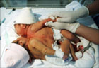 В Перу родились близнецы с одним сердцем на двоих. Фото