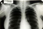 Рентгеновские снимки Мэрилин Монро уйдут с молотка. Фото