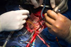 Уникальная операция по пересадке сердечного клапана проведена в Москве. Фото