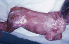 В Англии родился ребенок без кожи. Такое случается один раз на миллион случаев. Фото