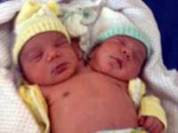 Бразильянка родила двухголового ребенка. Фото