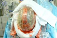 Специалисты из Нидерландов имплантировали женщине череп, напечатанный на 3D принтере