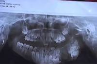 В Индии семилетнему мальчику удалили... 80 зубов