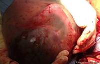 В США хирург сфотографировал ребенка, родившегося в плаценте