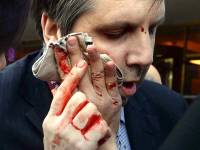 Послу США в Южной Корее порезали лицо бритвой