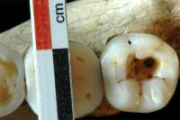 Археологи рассказали, как первобытные стоматологи боролись с кариесом