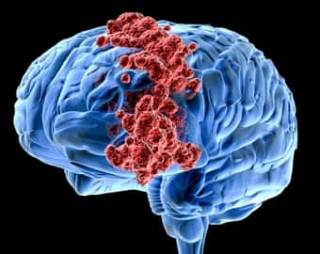 «Продвинутые» ученые предложили действенный метод лечения рака мозга