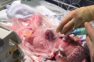 Хирурги впервые спасли новорожденного с сердцем вне тела