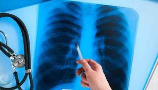 В Украине продолжается эпидемия туберкулеза. Заболеть может каждый