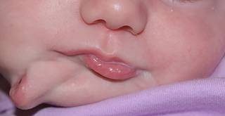 В США врачи успешно прооперировали девочку, у которой было два рта
