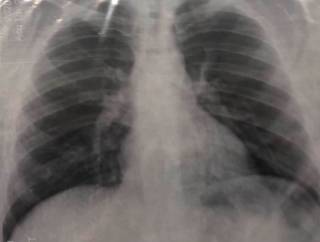 В Минздраве рассказали о бесполезности рентгена для диагностики коронавируса