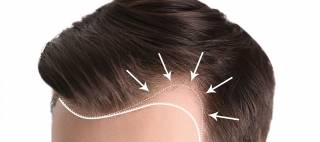 Как происходит пересадка волос и в каких случаях она может помочь