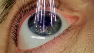 Лазерная коррекция зрения – удивительные возможности современной офтальмологии
