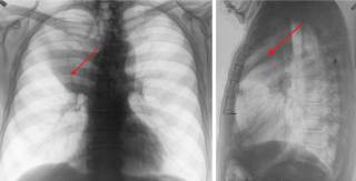 Подозрительные узелки в легких на рентгене: когда стоит беспокоиться?