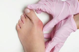 Каковы симптомы и лечение вальгусной деформации ног