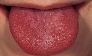 Скарлатина: малиновый язык, как характерный признак болезни