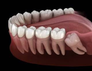 Які зуби можна видаляти і чому?