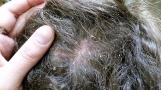 Себорейный дерматит на голове: лечение