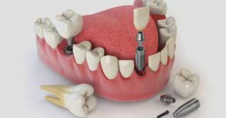 Одномоментная имплантация: эффективный и быстрый метод восполнения зубного ряда