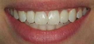 Найпопулярніші процедури в стоматології: вивчення зубних імплантатів та особливості імплантації