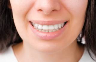 Елайнери - секрет рівних та білосніжних зубів