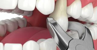 Видалення зуба: коли виникає потреба в хірургічному втручанні