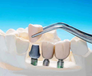 Імплантація зубів – найнадійніший спосіб повернення природної естетики посмішки