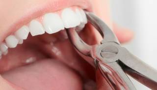 Удаление зуба: когда операция — единственный выход