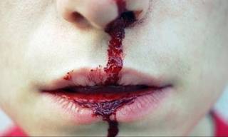 Почему идет кровь из носа у подростков?