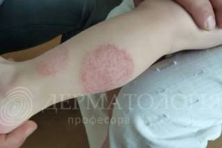 Когда кожа «плачет»: что важно знать о нумулярной экземе
