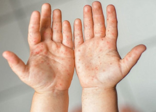 Українці стали частіше хворіти на кір – актуальна ситуація