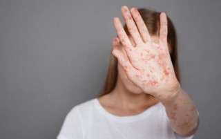 В Україні вдесятеро зросла захворюваність на кір