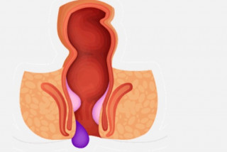 Геморрой - почему появляется заболевание