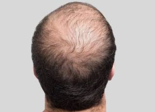 Ученые придумали новый способ борьбы с облысением