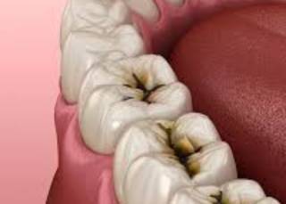 Американцы обнаружили новый способ предотвращения кариеса