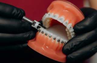 Брекети: коли естетика переходить у реальну корекцію прикусу